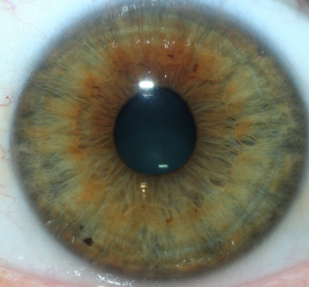 iridology pictures 3