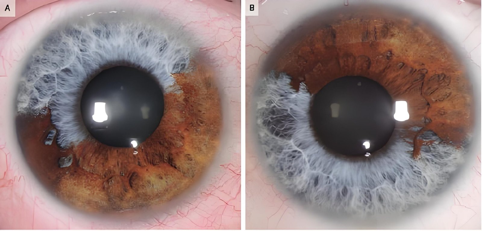 Primer plano detallado del iris humano mostrando diferentes manchas y pigmentaciones características del análisis iridológico