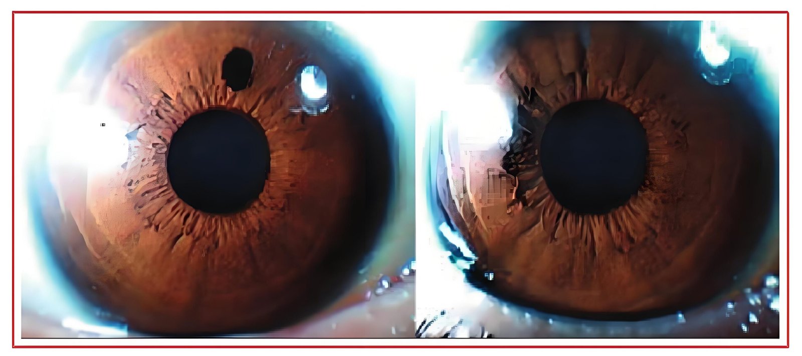 Primer plano detallado del iris humano mostrando diferentes manchas y pigmentaciones características del análisis iridológico