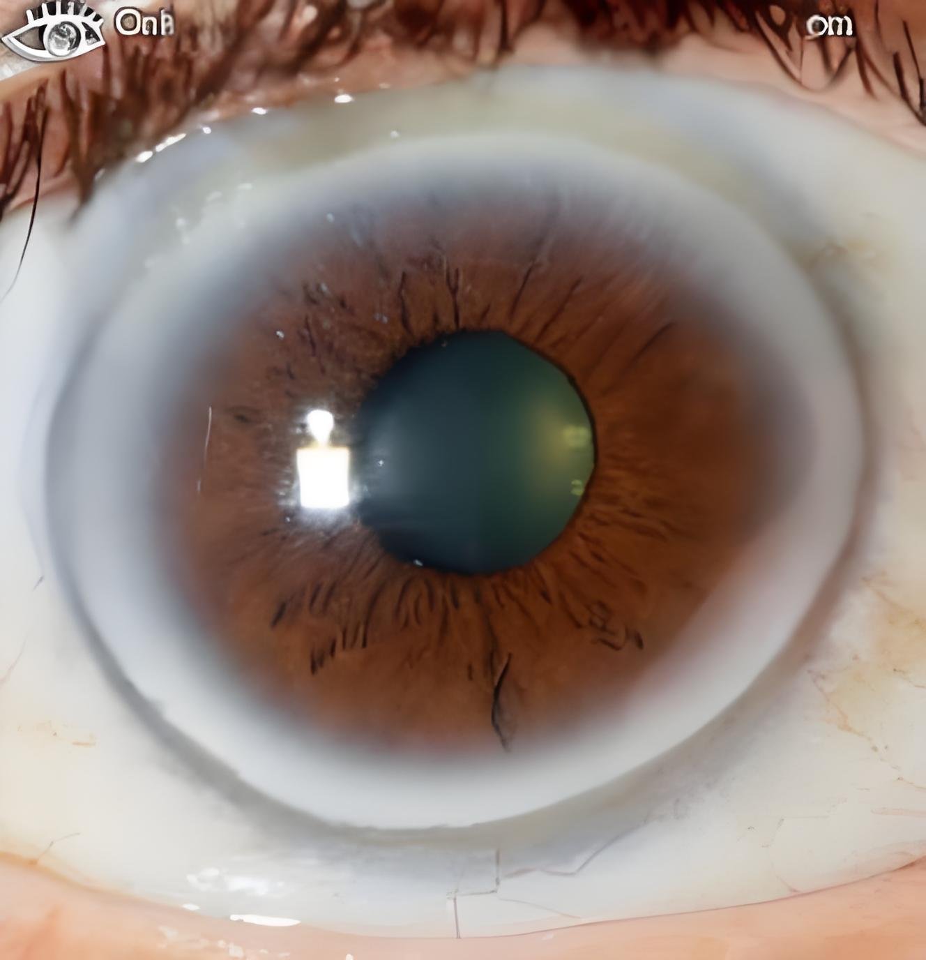 Iridology eye color