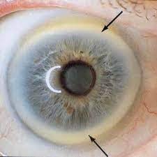 Iridology Iris sodium ring (4)