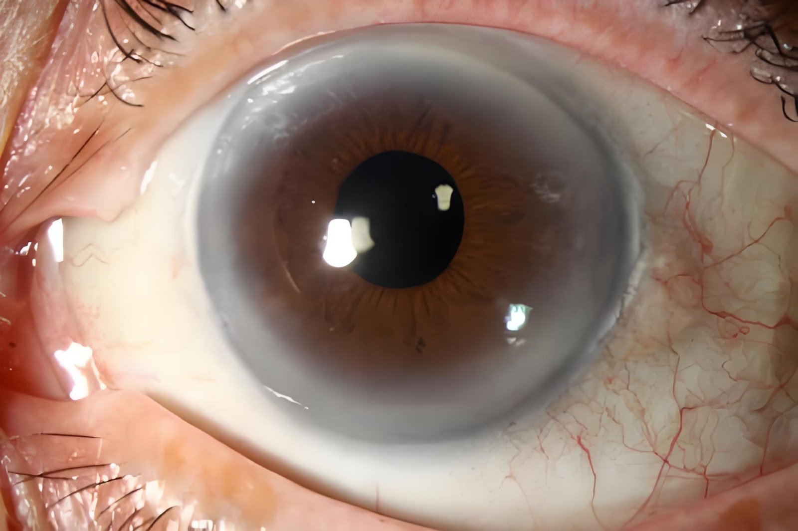 Iridology Iris sodium ring (4)