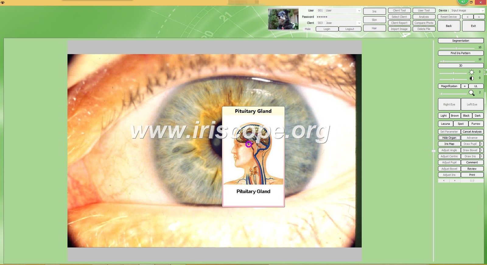 Irisoft Software de Iridología 16 iridology software reports
