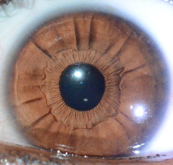 ejemplo de radii solaris en iris según metodología jensen