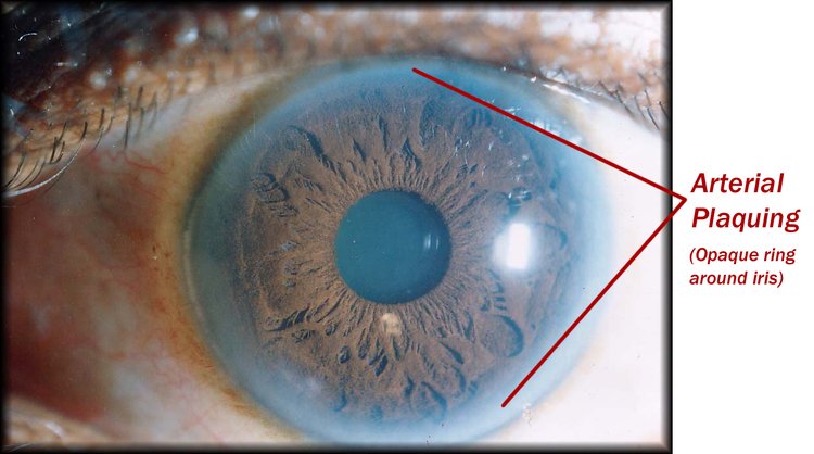 ejemplo de anillo de sodio en iris según clasificación de bernard jensen