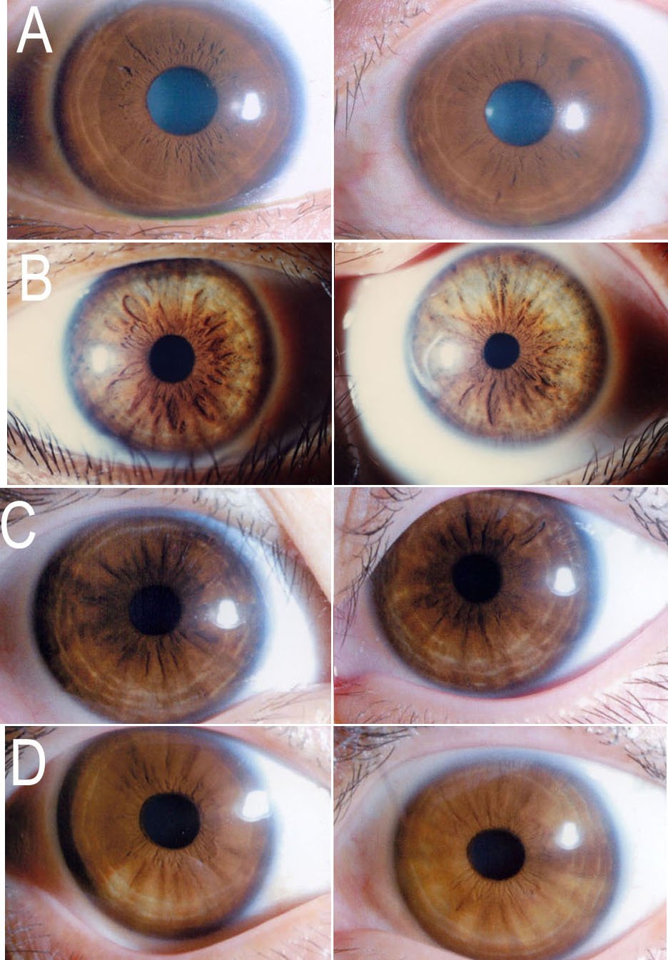 Iridology eye color