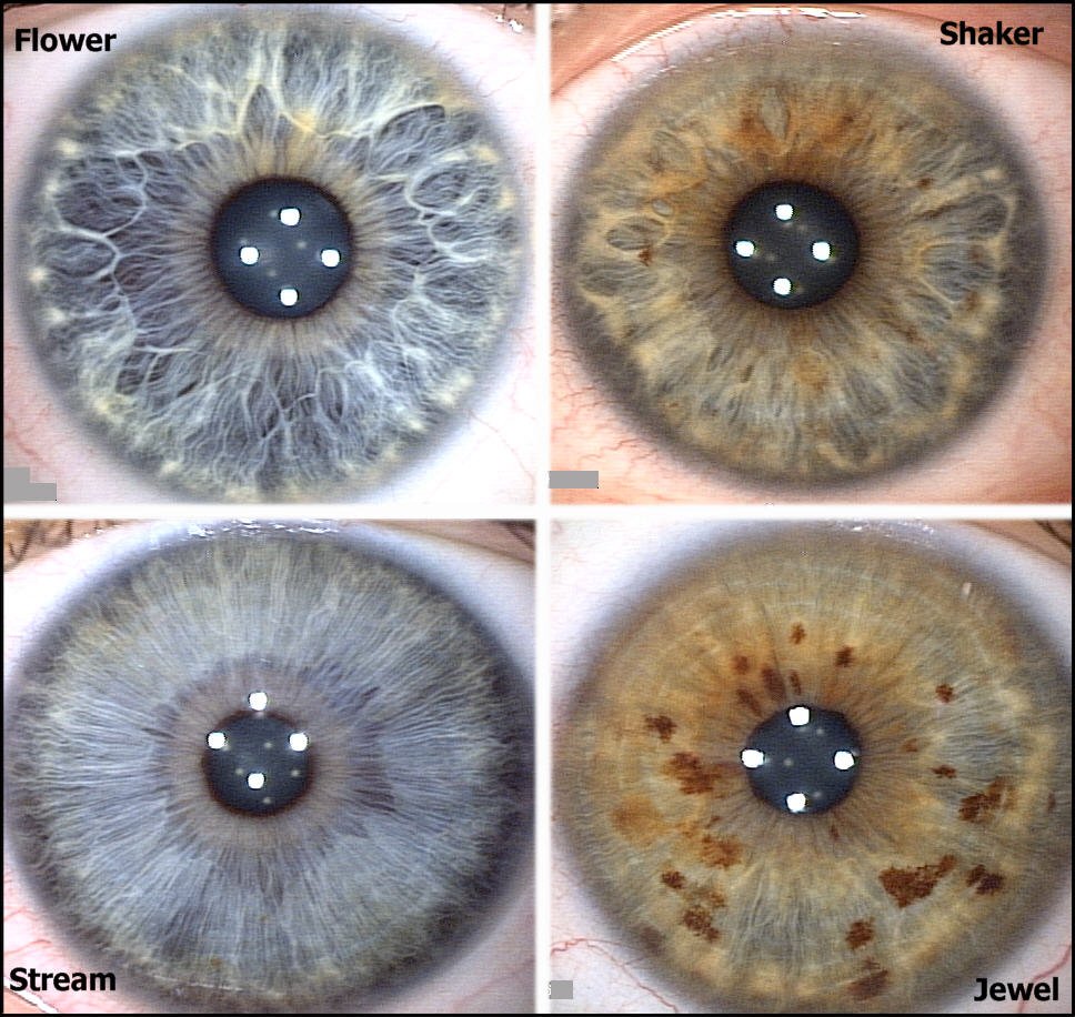 iridology before and after