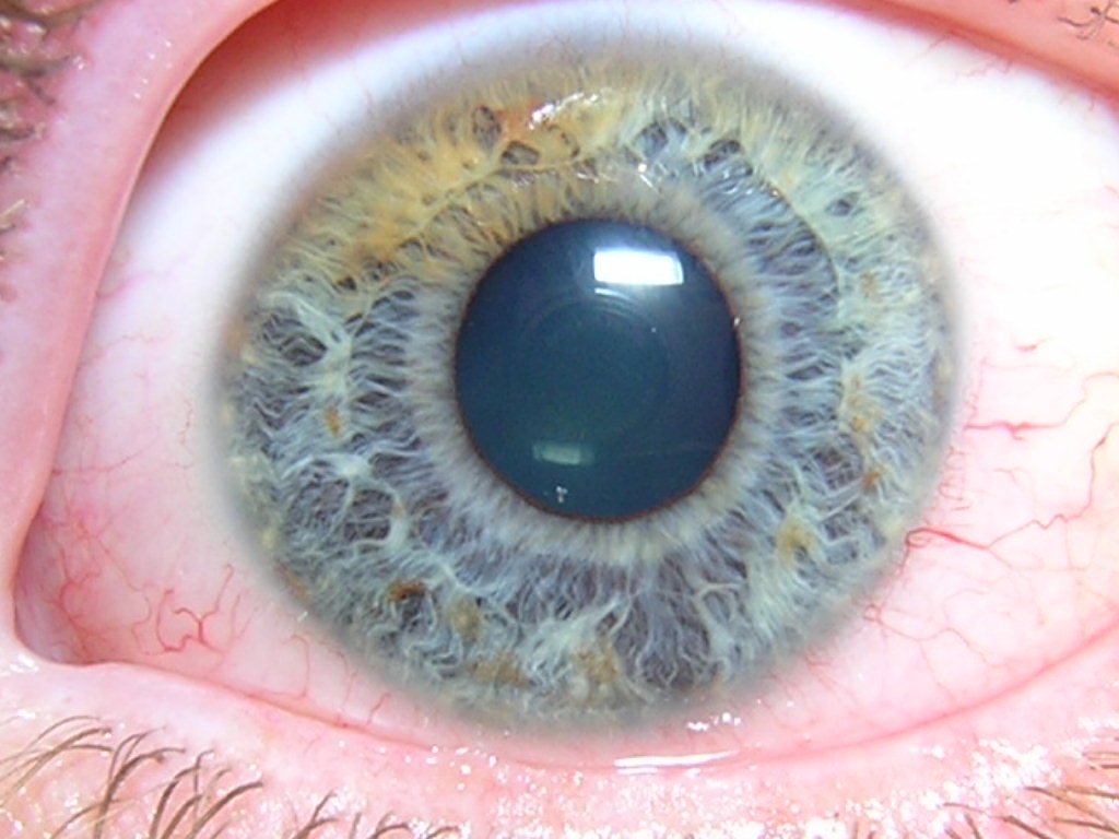 iridology brown eyes
