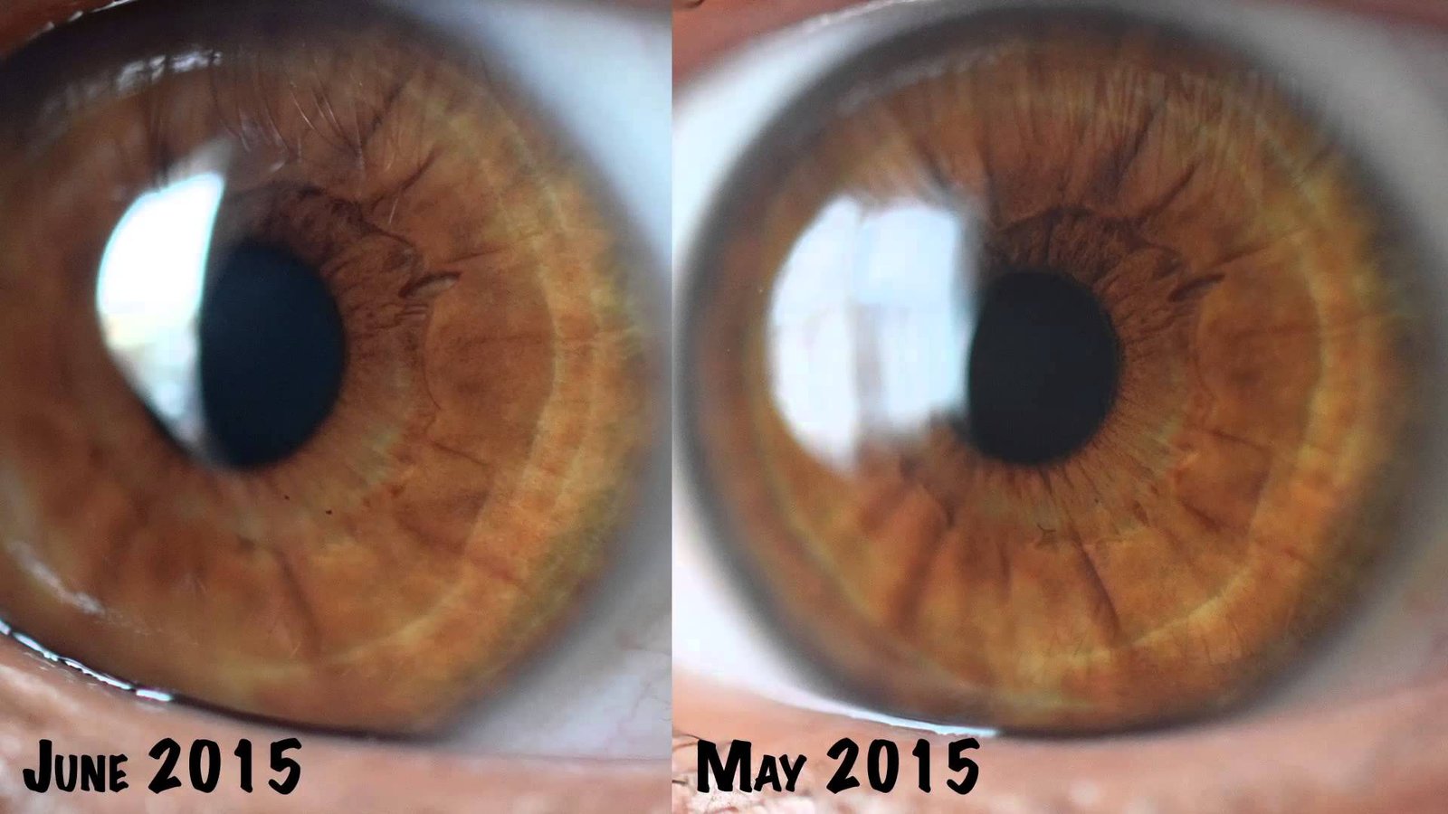 Comparación lado a lado de análisis iridológico antes y después mostrando cambios en pigmentación y estructura tras intervención terapéutica