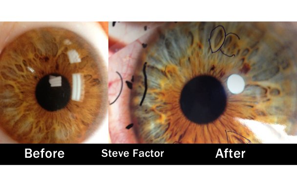 Comparación de iris antes y después de tratamiento holístico mostrando cambios positivos