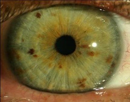 Primer plano detallado del iris humano mostrando diferentes manchas y pigmentaciones características del análisis iridológico