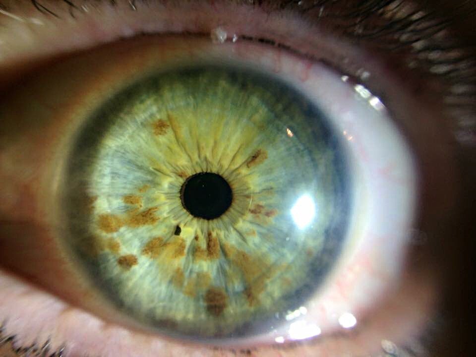 Primer plano detallado del iris humano mostrando diferentes manchas y pigmentaciones características del análisis iridológico